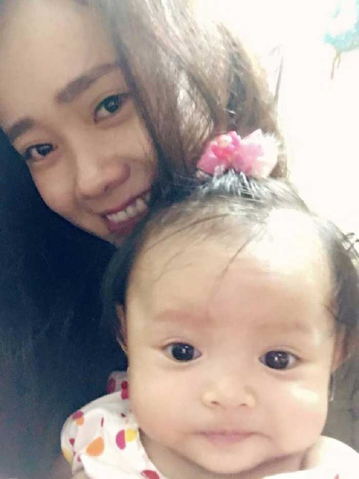 Nâng mũi bọc sụn