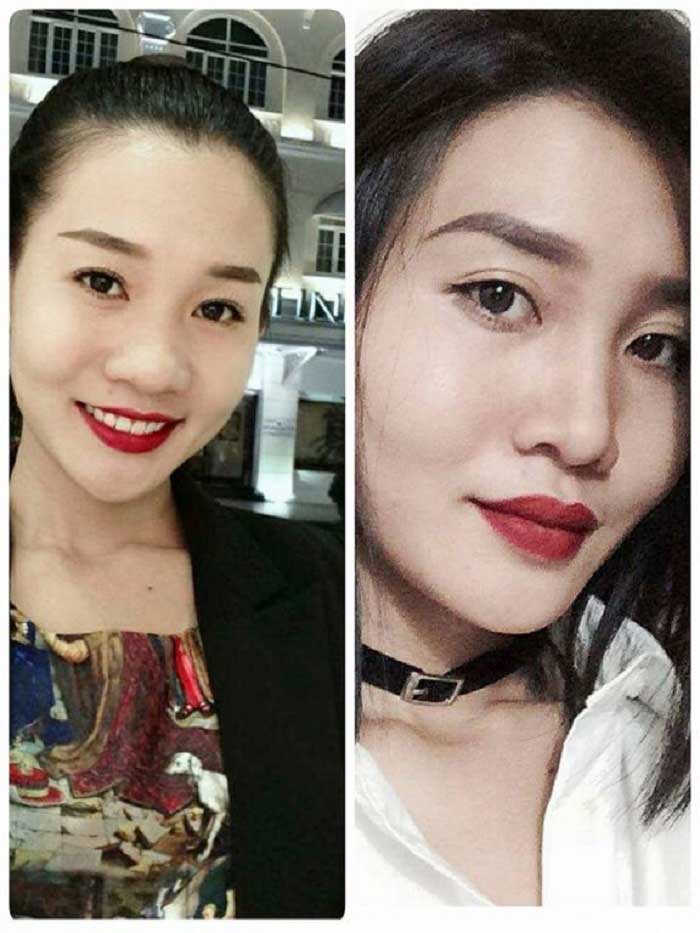 Nâng mũi filler