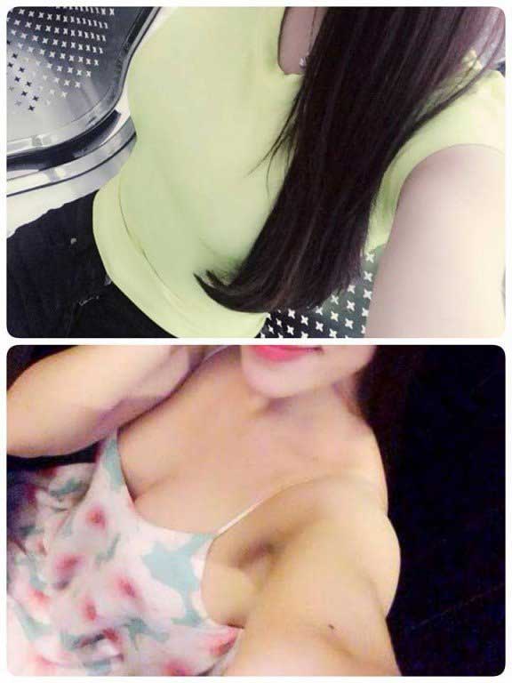 Nâng ngực nội soi