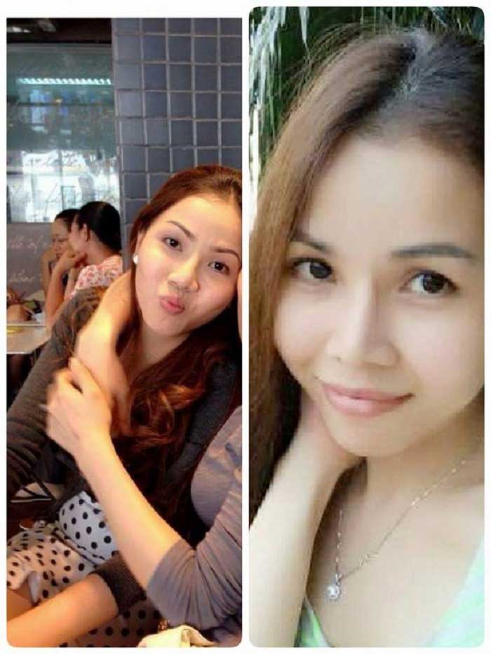 Nâng mũi Hàn Quốc