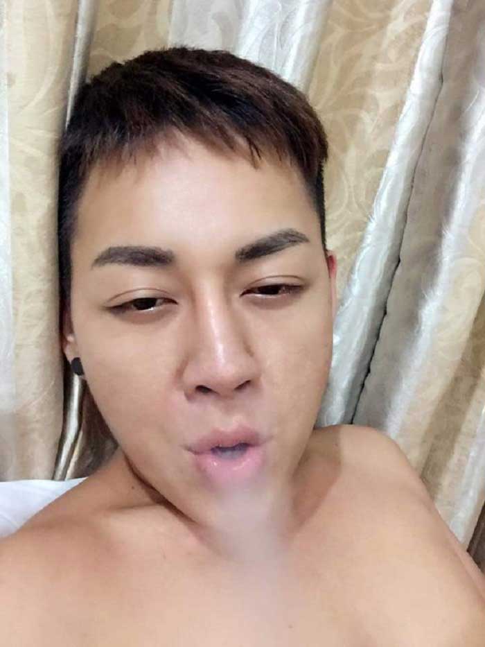 Nâng mũi bọc sụn