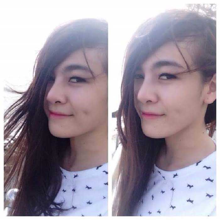 Nâng mũi Hàn Quốc