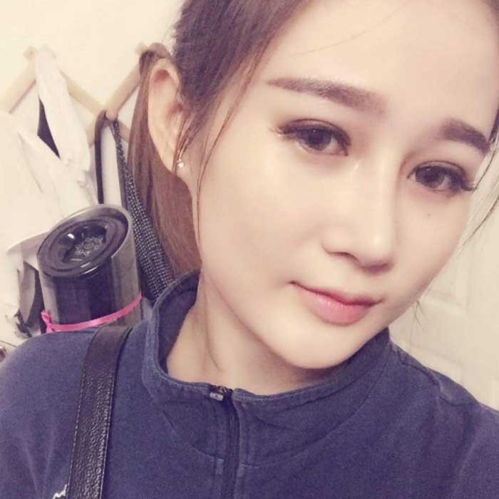 Nâng mũi Hàn Quốc