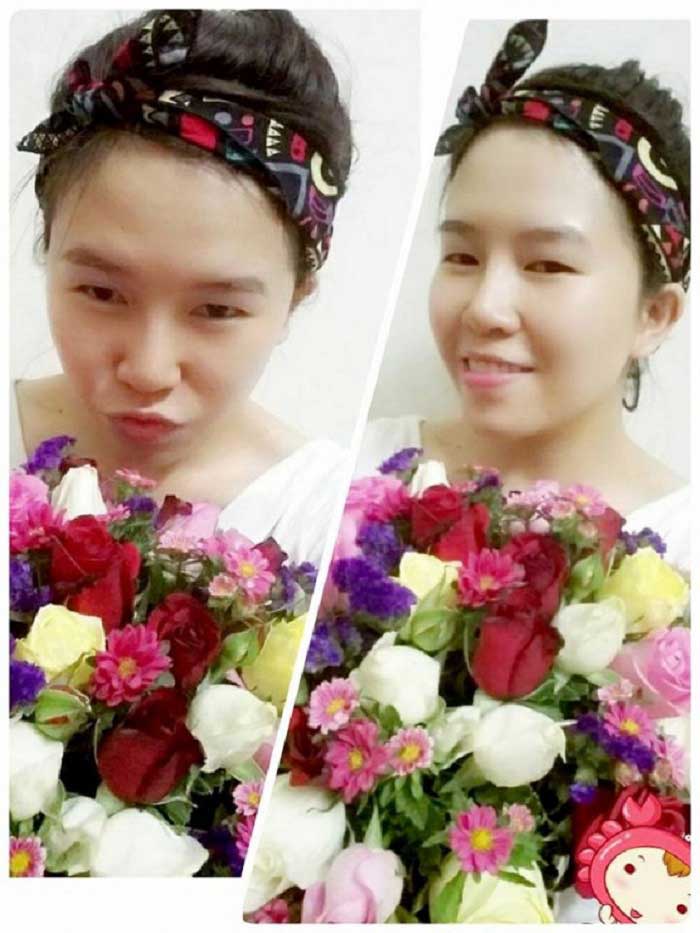 Nâng mũi bọc sụn