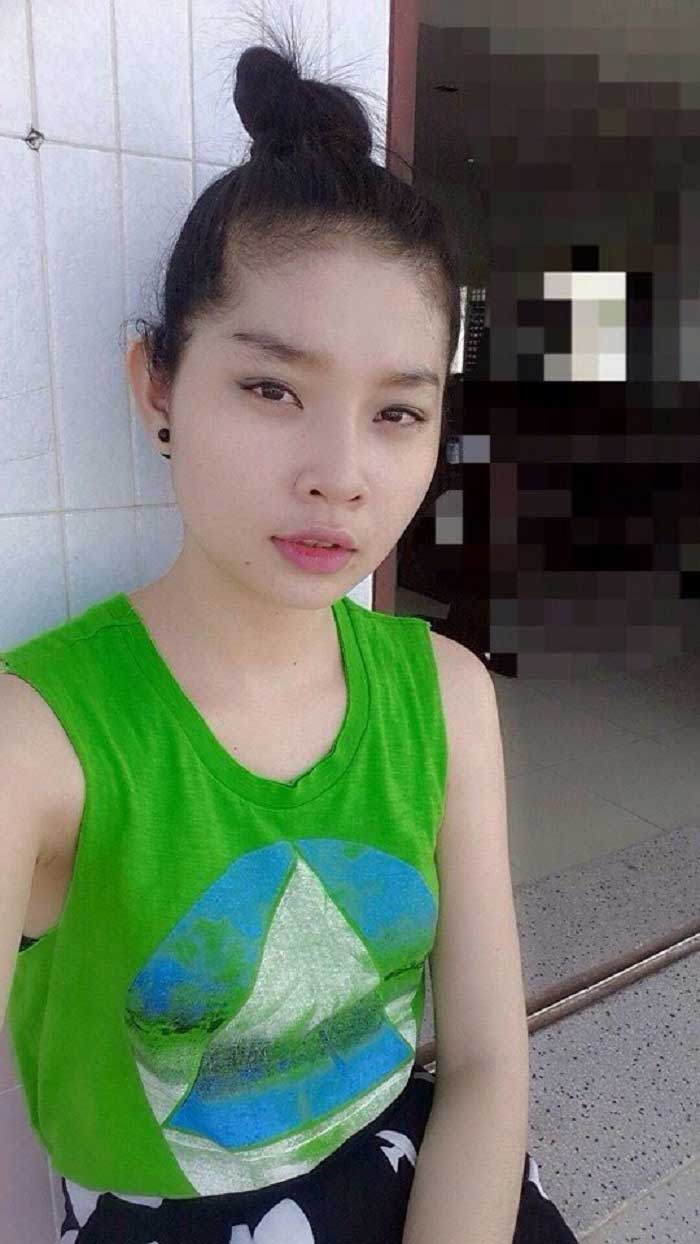Nâng mũi bọc sụn