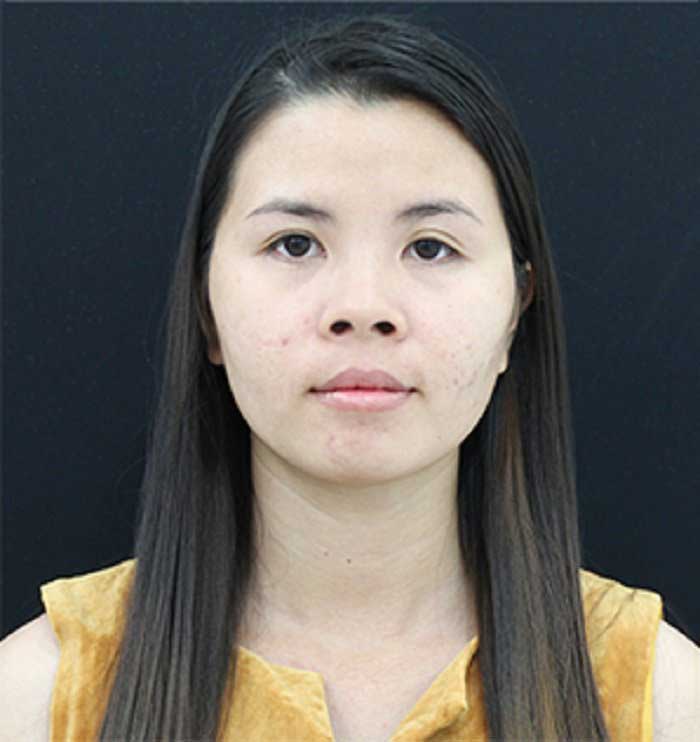 Nâng mũi bọc sụn Nâng mũi bọc sụn