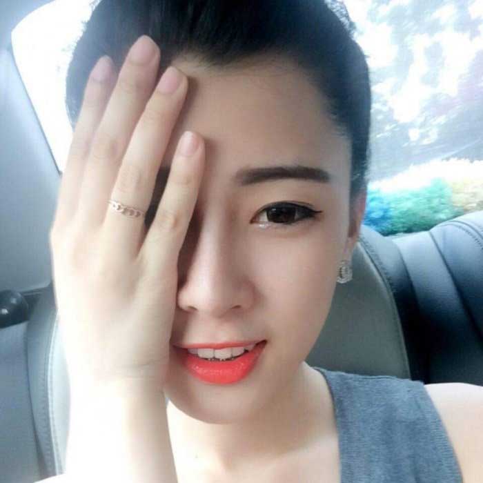 Nâng mũi bọc sụn
