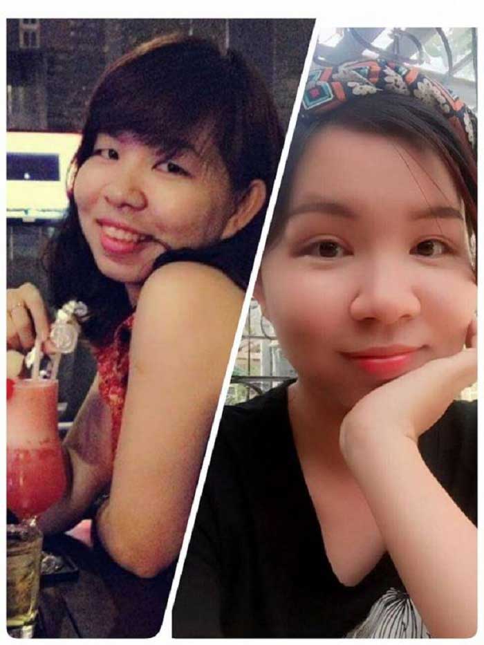 Cắt mí mắt