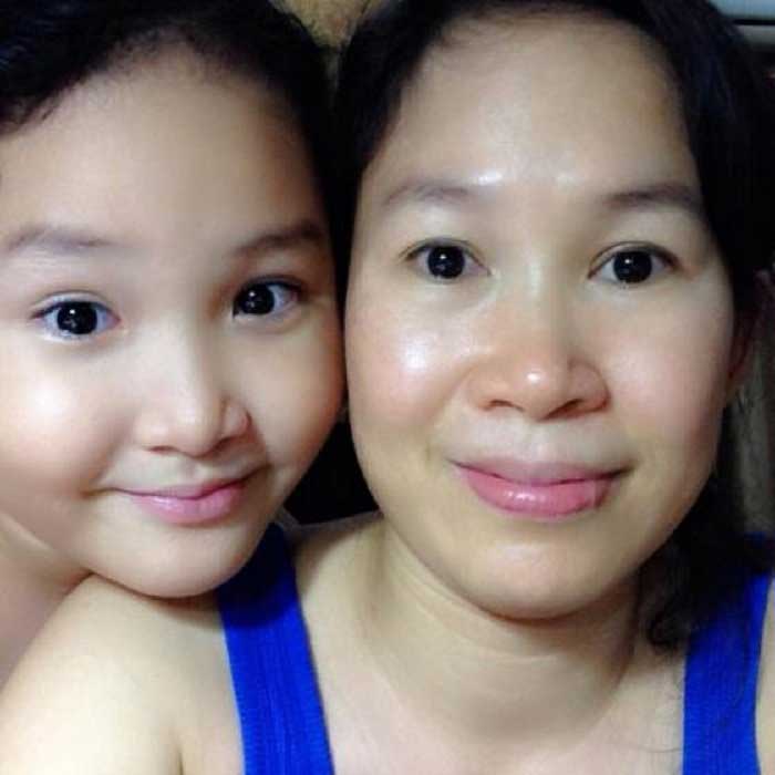 Cắt mí mắt
