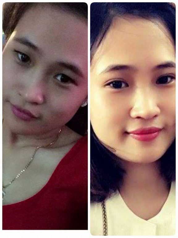 Bấm mí Hàn Quốc