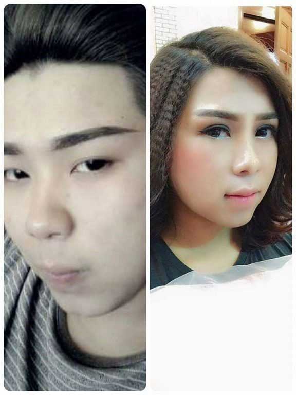 Bấm mí Hàn Quốc