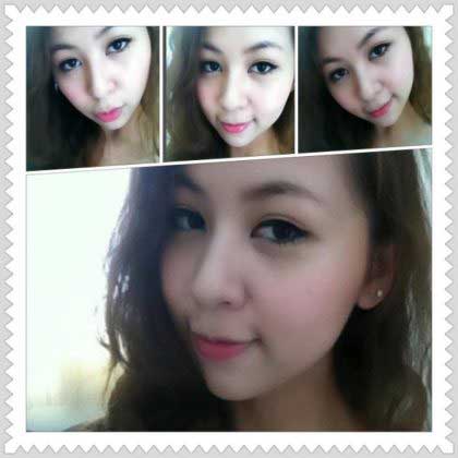 Độn cằm