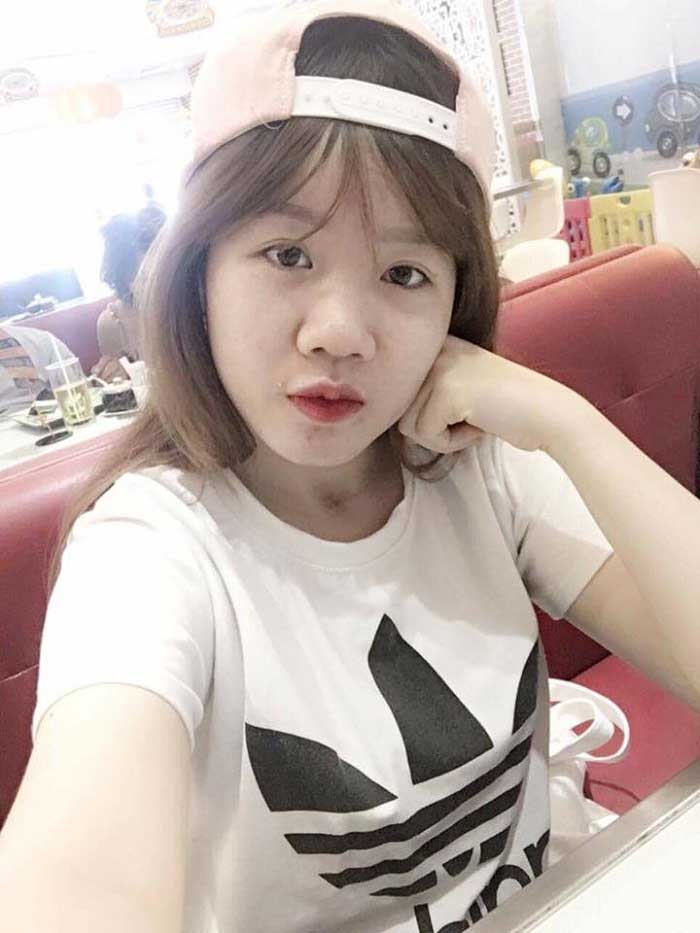 Nâng mũi Hàn Quốc