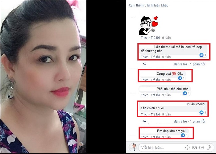 Nâng mũi bọc sụn