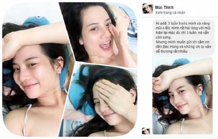 Nâng mũi bọc sụn