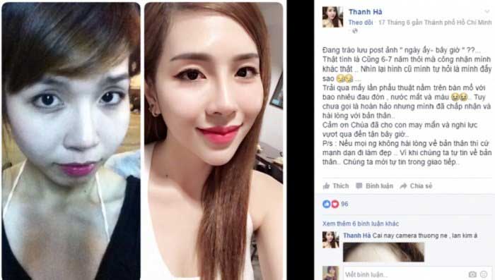 Nâng mũi Hàn Quốc
