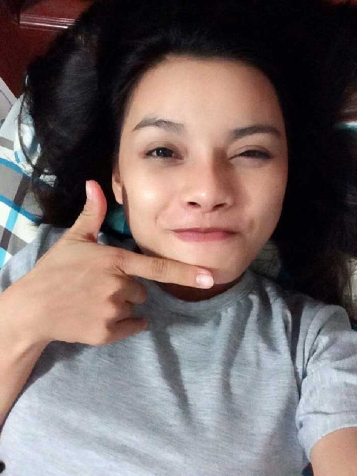 Nâng mũi bọc sụn
