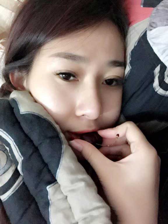 Nâng mũi S Line 