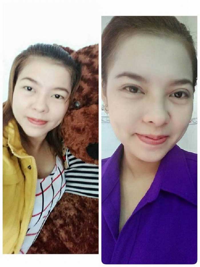 Cắt mí mắt
