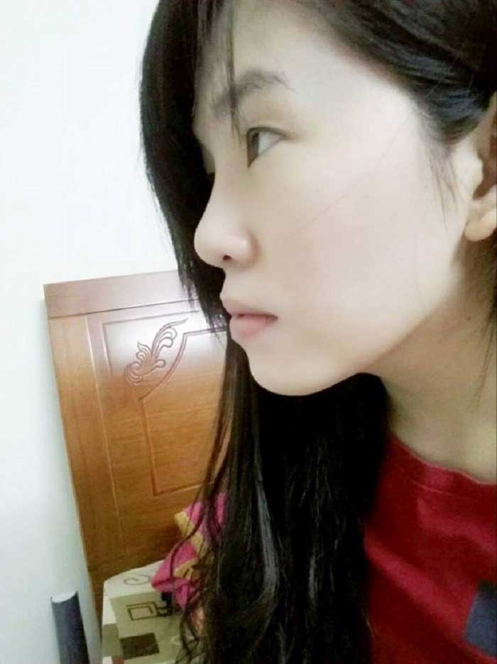 Nâng mũi bọc sụn