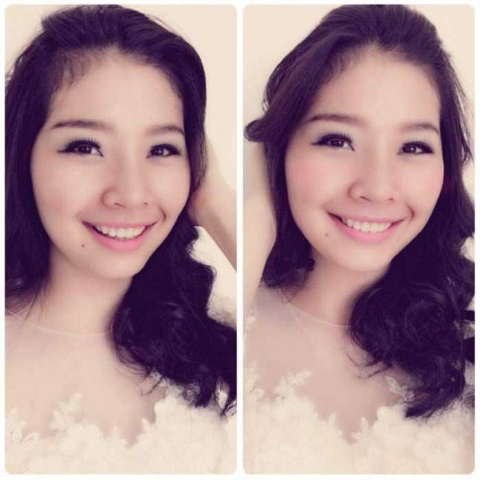 Nâng mũi bọc sụn