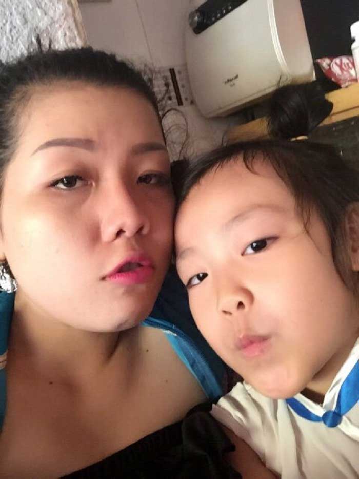 Cắt mí mắt