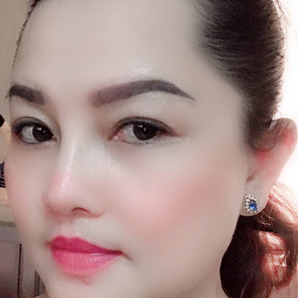 Nâng mũi bọc sụn