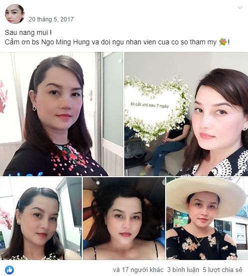Nâng mũi bọc sụn
