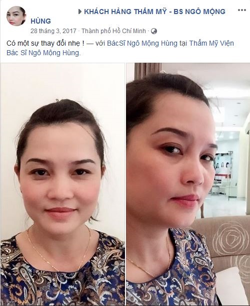 Nâng mũi bọc sụn