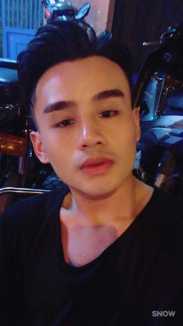 Nâng mũi bọc sụn