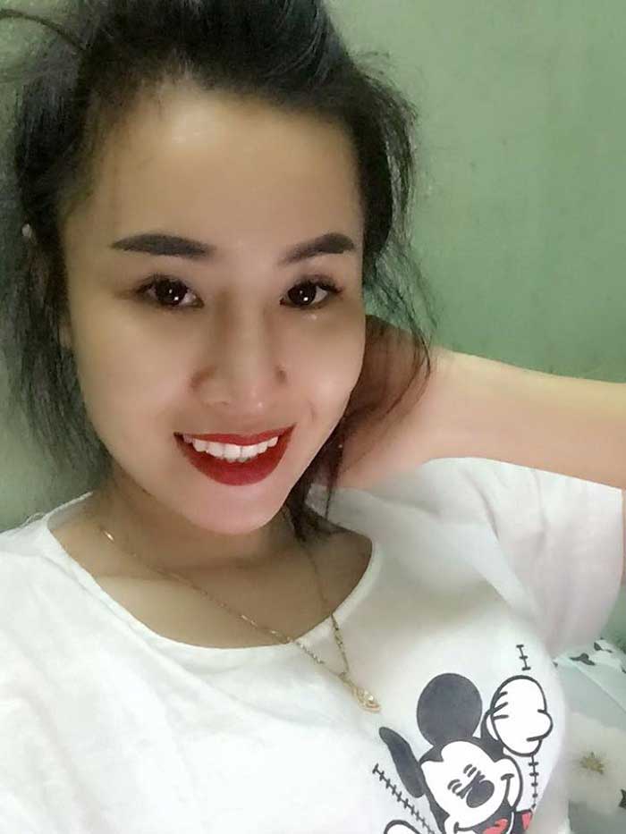 Nâng mũi Hàn Quốc