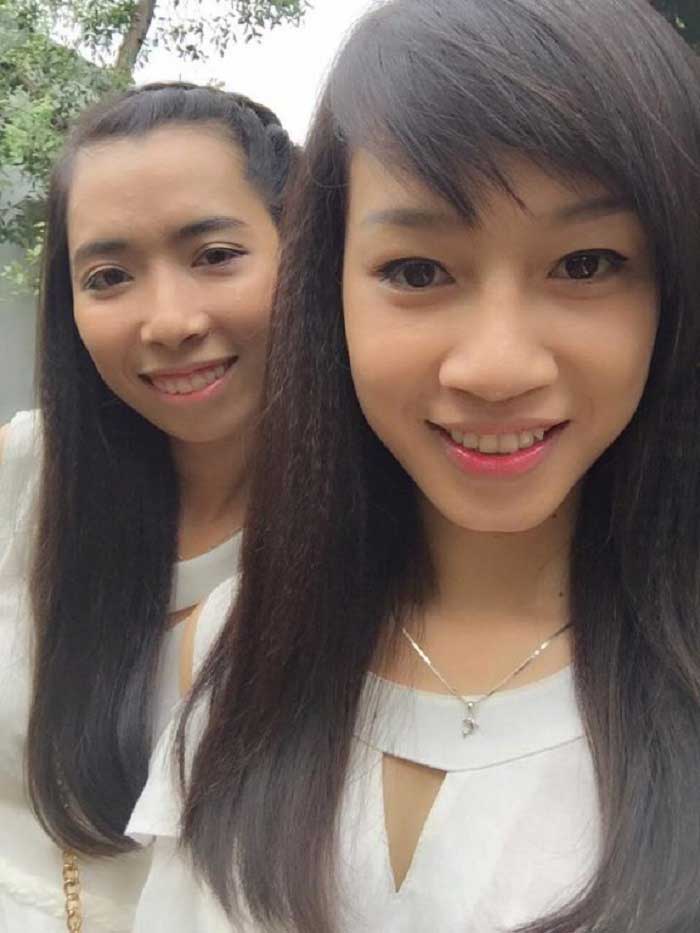 Nâng mũi bọc sụn
