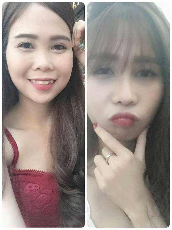 Nâng mũi S Line