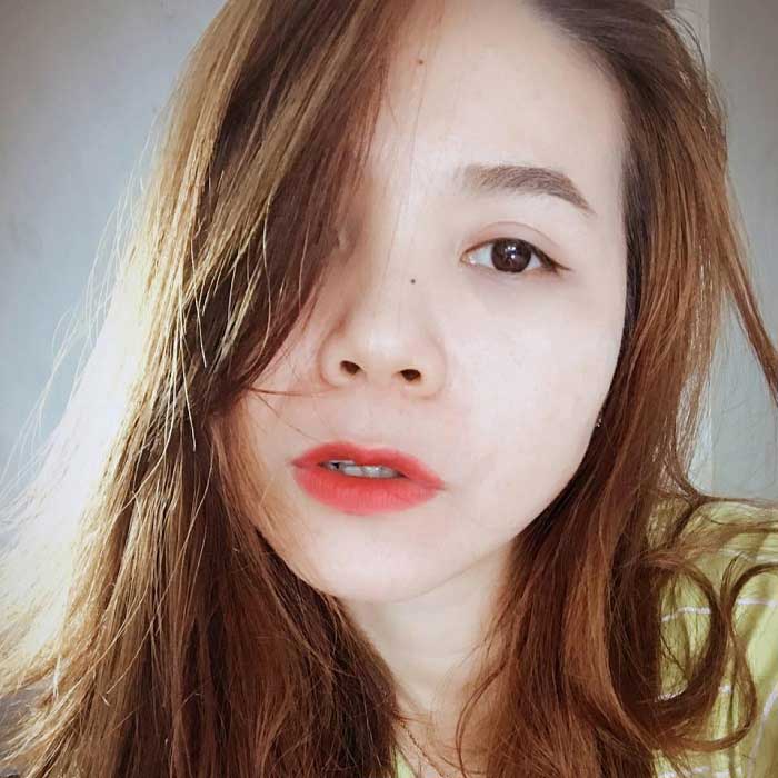 Cắt mí mắt