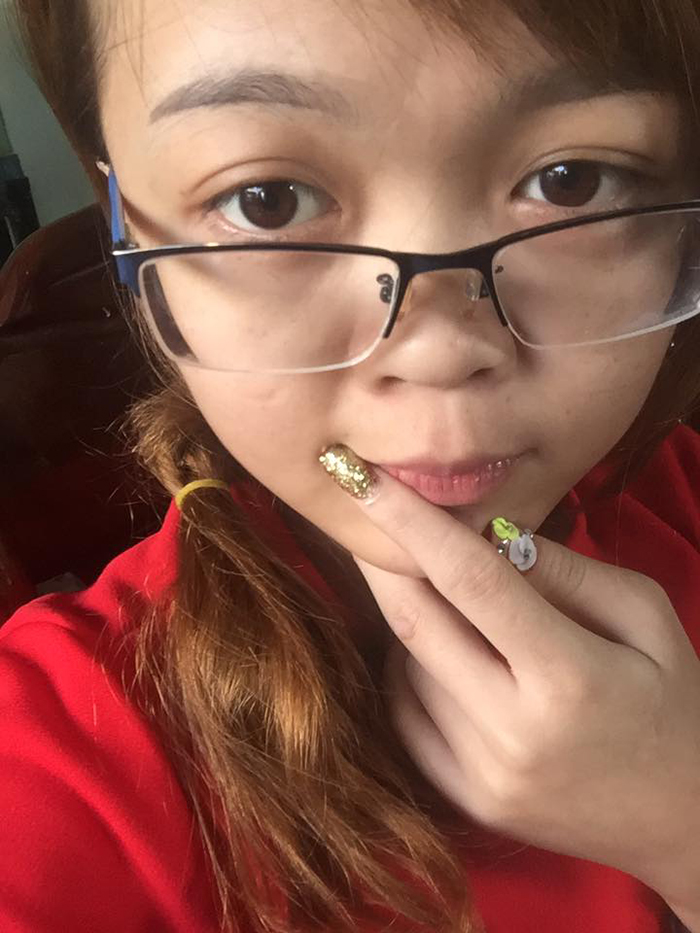 Nâng mũi bọc sụn