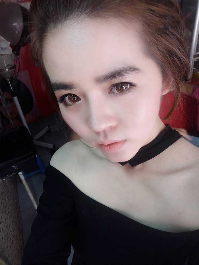 Nâng mũi Hàn Quốc