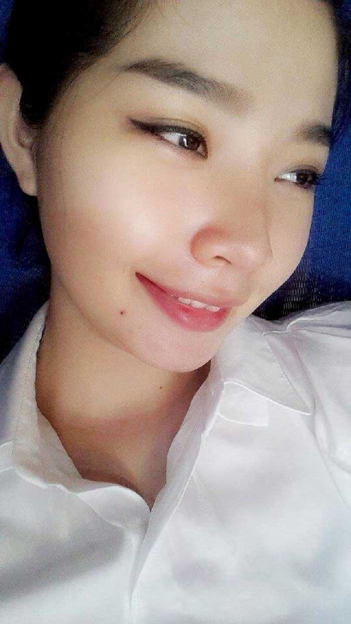 Nâng mũi bọc sụn