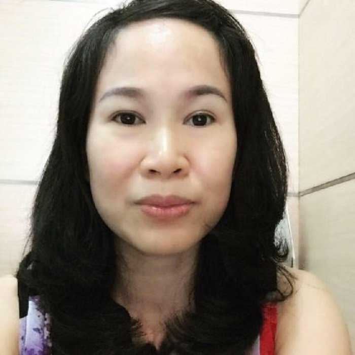 Cắt mí mắt