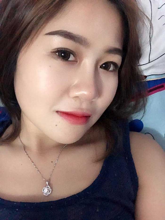 Nâng mũi bọc sụn