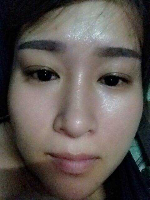 Cắt mí mắt