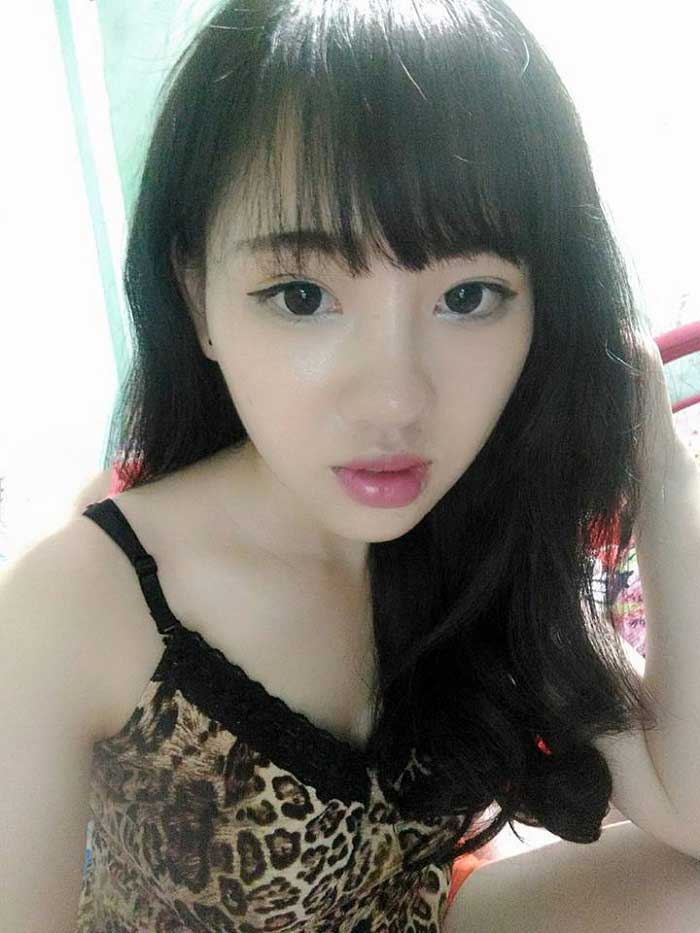 Nâng mũi bọc sụn