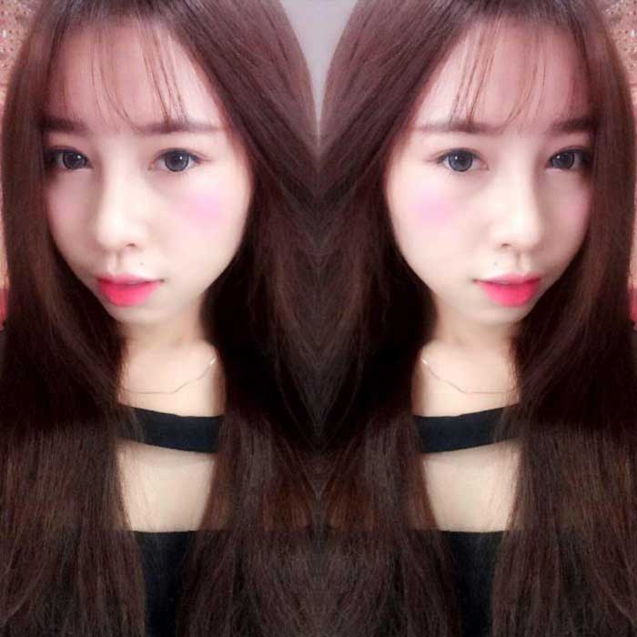 Nâng mũi bọc sụn