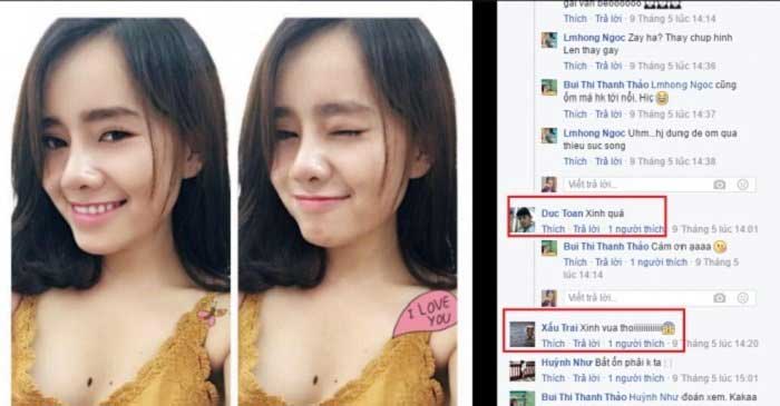 Nâng mũi bọc sụn