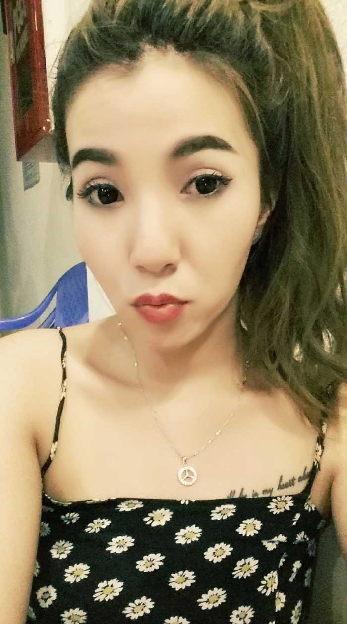 Cắt mí mắt