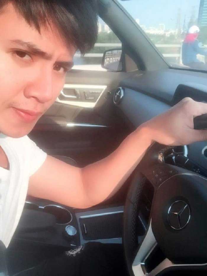 Nâng mũi bọc sụn