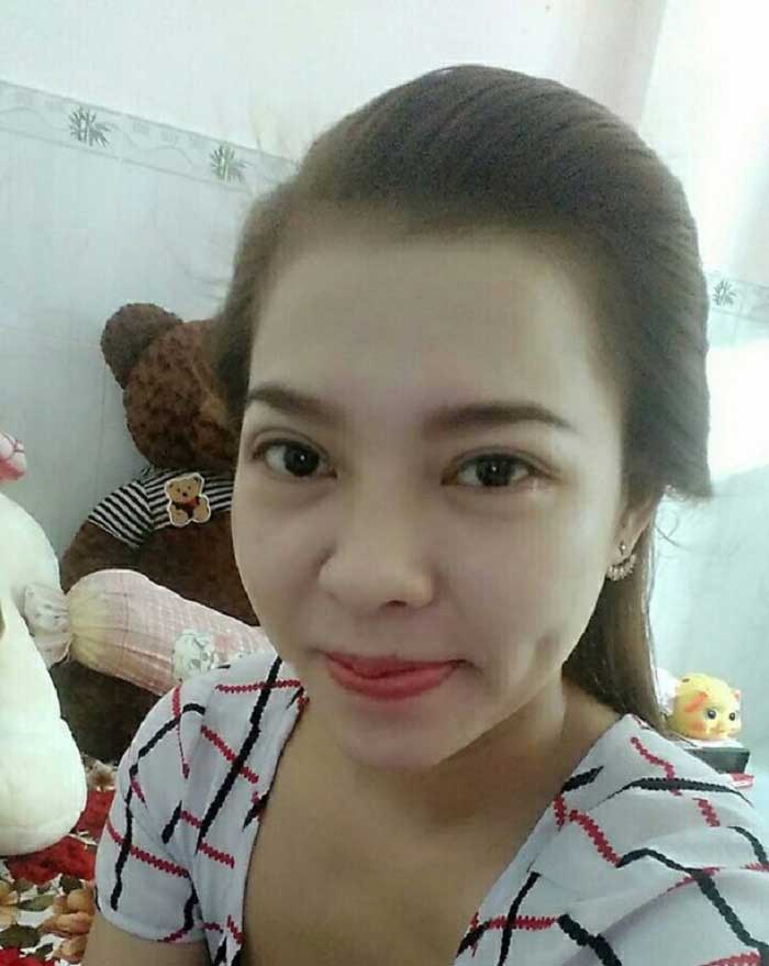Cắt mí mắt