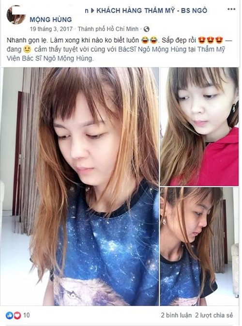 Nâng mũi bọc sụn
