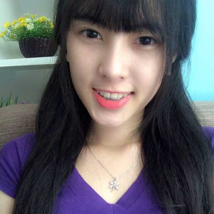Nâng mũi bọc sụn