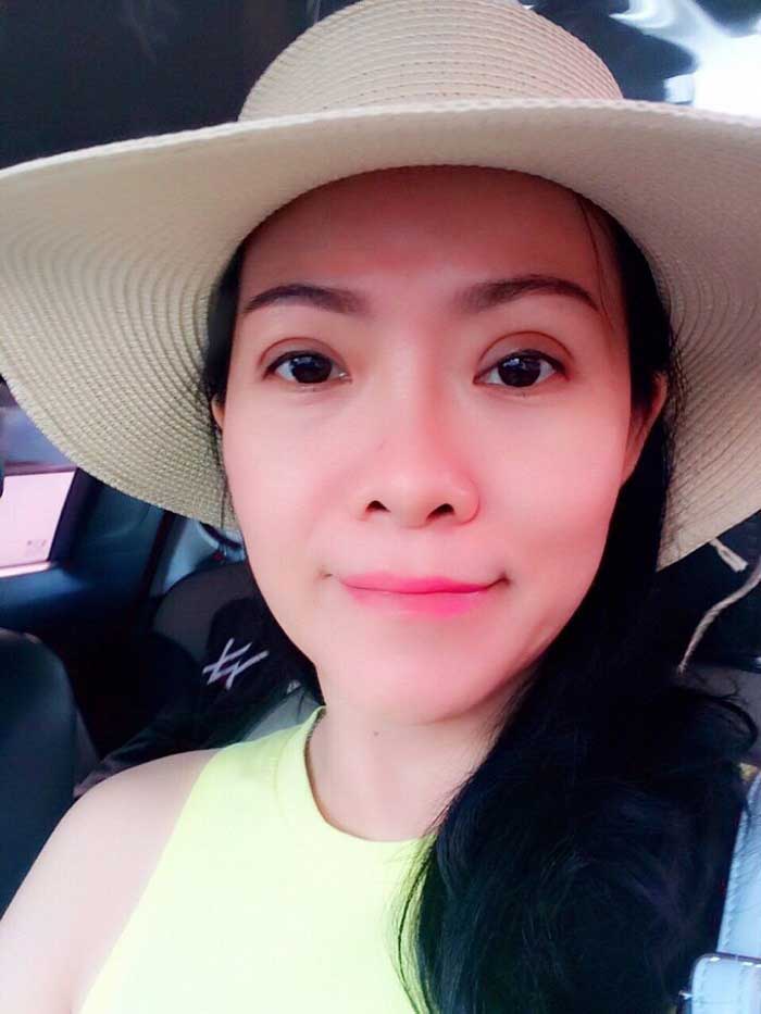 Nâng mũi bọc sụn Nâng mũi bọc sụn