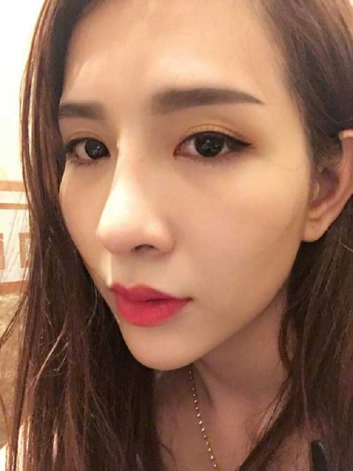 Nâng mũi Hàn Quốc